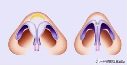 鼻翼缩小鼻骨内推手术,宽鼻头缩窄手术好做吗