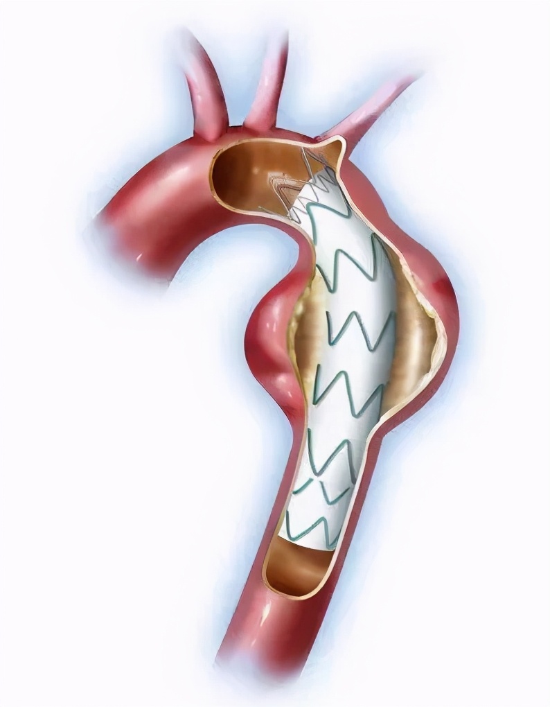 小伙被感染梅毒,感染梅毒胸口会不会不舒服