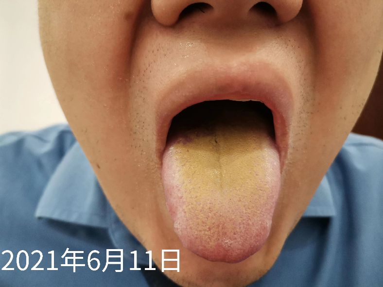 黄苔怎么造成的,黄苔一定是实热吗