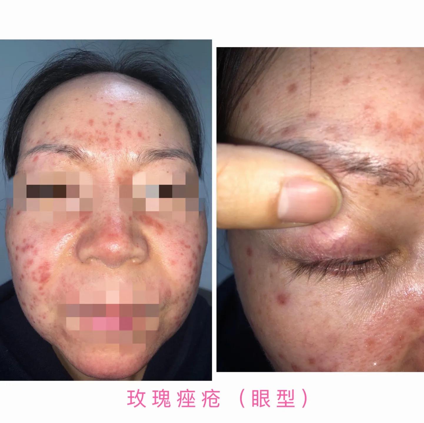 过敏脸上身上全是红痘痘,脸红就是玫瑰痤疮吗