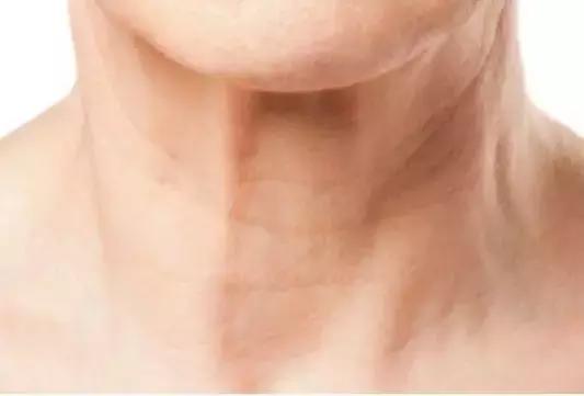 明星如何祛颈纹,女生颈纹很深该怎么解决