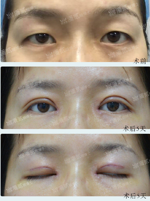 开内眼角失败留疤了怎么办,开外眼角恢复期间会有紧绷感么