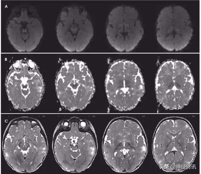 脑卒中病历诊断书图片,脑卒中影像判断技巧图解电子版
