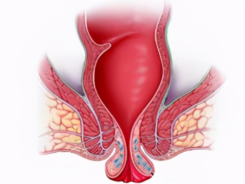 痔疮脱垂不等于直肠脱垂!两者区别大,千万不要混淆了