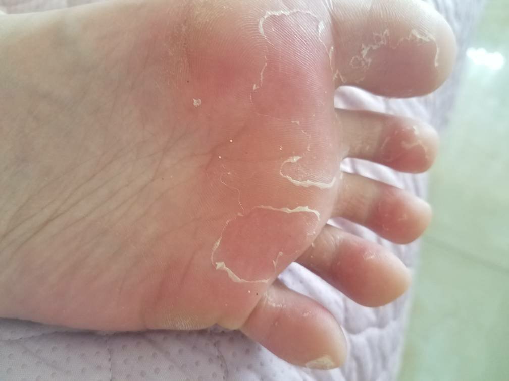 脚痒一直好不了是怎么回事,脚痒很多年了一直没治好