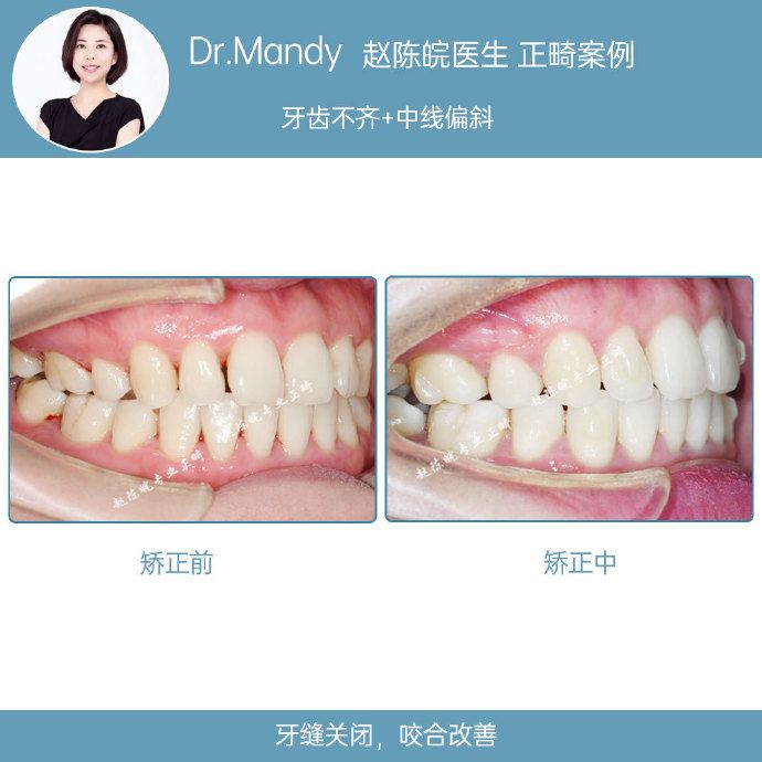 正畸牙齿不齐案例,牙齿拥挤正畸真实案例