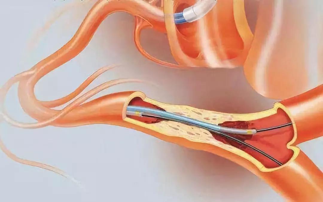 颅内肿瘤微创介入的条件,广东哪家医院肿瘤微创介入治疗好