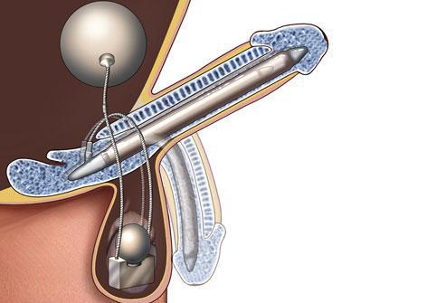 涨姿势！男性勃起障碍很可怕？听过用松紧带和真空泵
