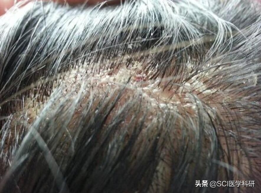 人为什么会长头皮屑简单的回答,头皮屑是什么细胞产生的