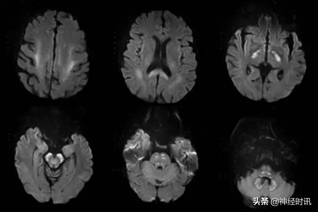 脑卒中的快速识别ppt,脑卒中神经影像学实例解析