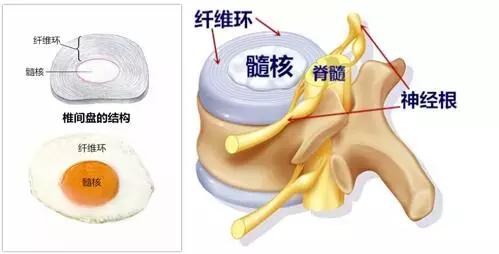 腰椎间盘突出症误区,腰椎间盘突出症的十个注意事项