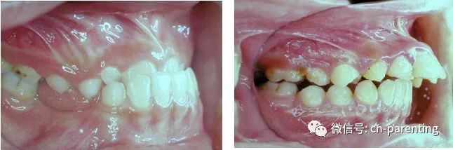 小孩牙矫正的全过程,8岁儿童牙齿矫正兜齿过程全记录