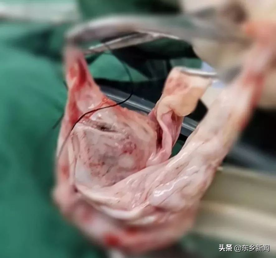 腹腔镜手术切除巨大卵巢囊肿,卵巢囊肿腹腔镜手术单孔