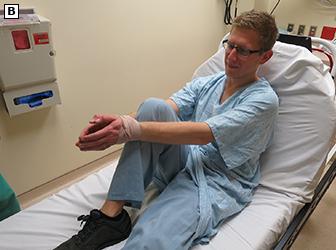 肩脱臼了怎么恢复,肩脱臼怎么彻底恢复