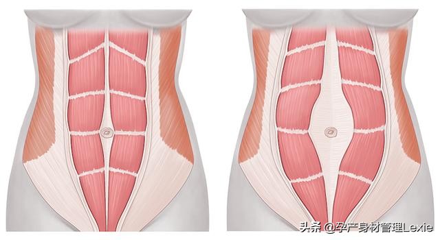 产后腹直肌分离怎么锻炼可以恢复,产后腹直肌分离修复手法教程
