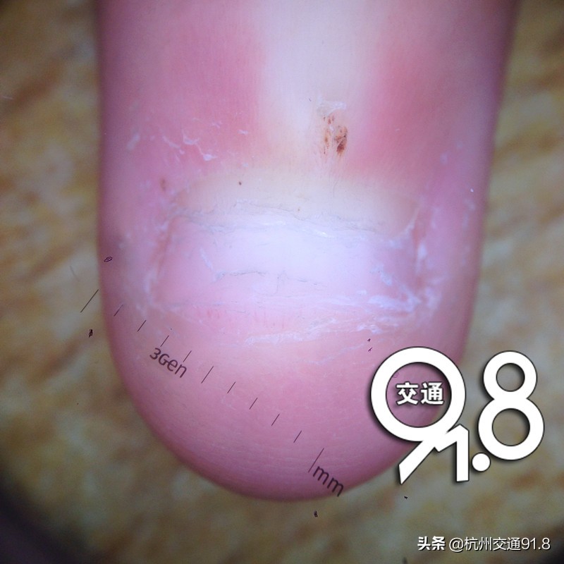 11岁女孩有斑秃,11岁女孩突然掉发斑秃