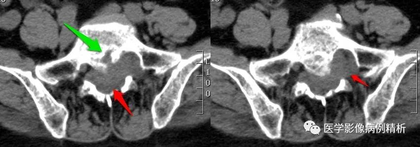 海绵状血管瘤在mri中的影像表现,骶骨处影像显示有血管瘤