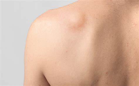 卵黄囊瘤是睾丸癌吗,卵黄囊瘤是不是生殖细胞瘤