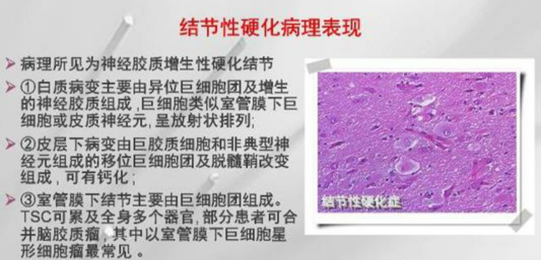 儿童结节性硬化症癫痫,遗传性癫痫伴有结节硬化能治愈吗