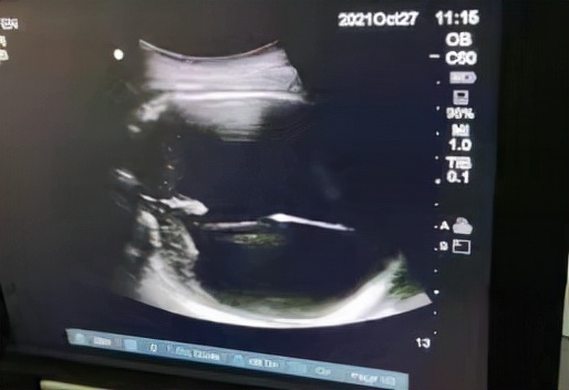 胎儿脑积水有必要做穿刺,新生儿脑积水穿刺