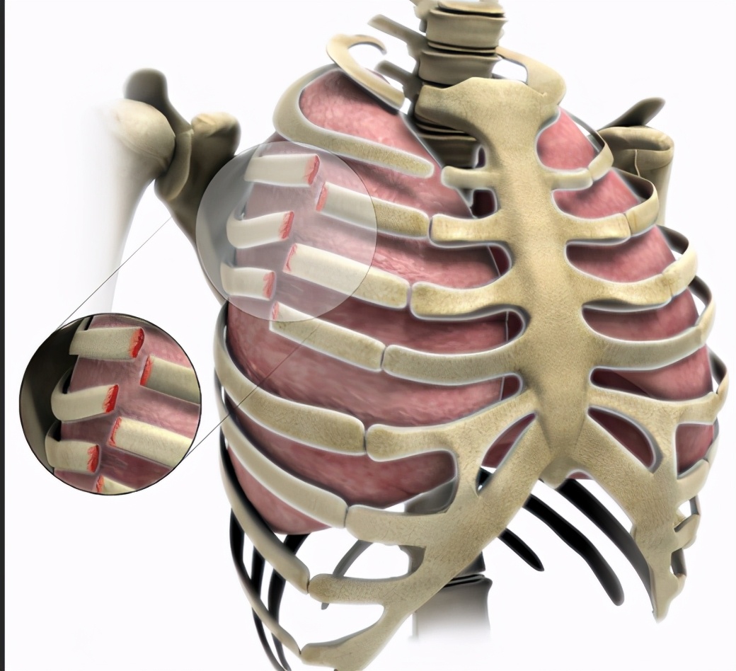 摔了一跤肋骨骨裂碍事吗,摔折八根肋骨治好了会留后遗症吗