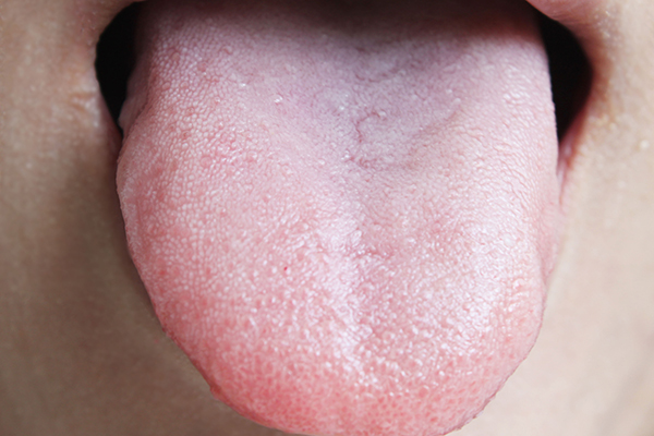 口腔溃疡一个月不愈合就是舌癌,长时间口腔溃疡不治疗容易患舌癌