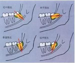 长智齿为什么老一辈不建议拔智齿,拔智齿后的心得分享