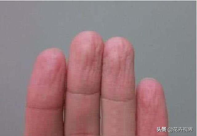 为什么手泡在水里泡久了会褶皱,手在水里泡一会就皱巴巴是为什么