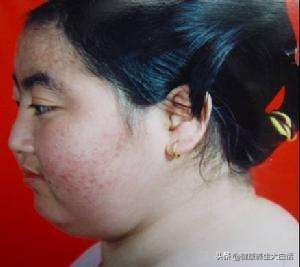 地塞米松真的对新冠肺炎有效吗,地塞米松会导致死亡么