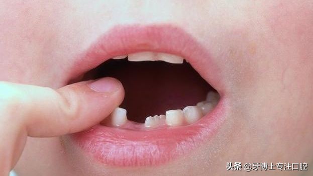 小宝换牙之前牙齿很小很整齐,宝宝牙齿不整齐换牙后会好吗