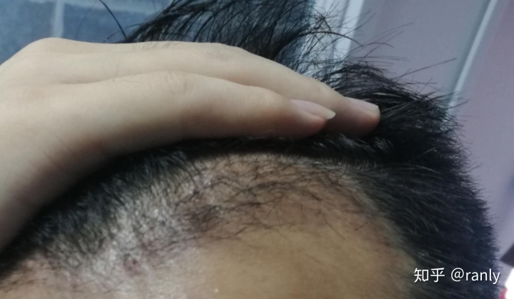 植发日记是什么,植发日记vlog第六天