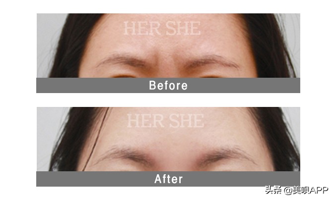 不做医美真的会快速衰老吗,为什么医美使得皮肤衰老更快