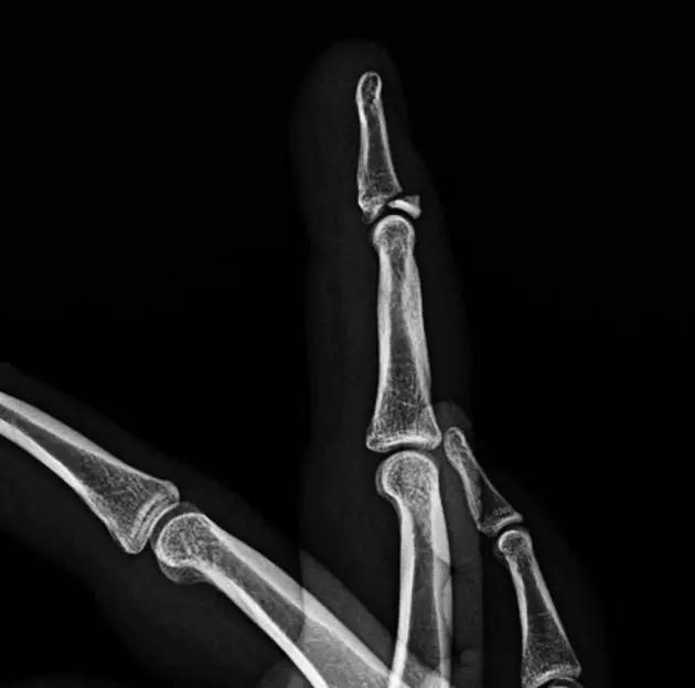 所有骨折都叫什么名字,骨折的名称有哪些