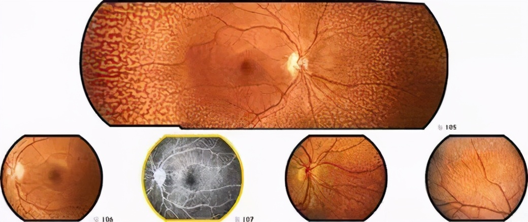 视网膜色素变性症状有哪些,视网膜色素变性会越来越严重吗