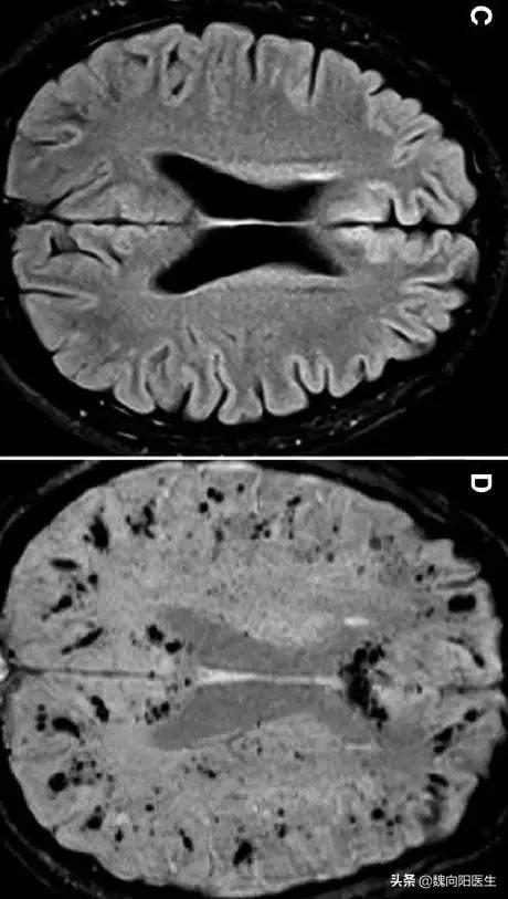 缺血性卒中腔隙性脑梗死,检查结果是腔隙性脑梗死严重吗