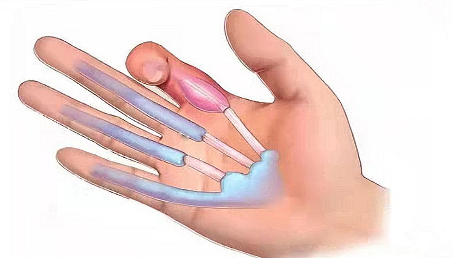 中年妇女手指疼痛僵硬是什么原因,老人手指腱鞘炎如何治疗