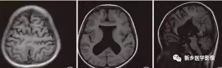 脑室影像学表现,脑室占位影像