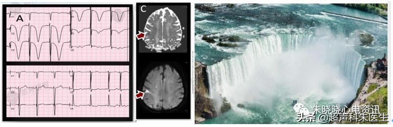 t波倒置9个真相图解,t波倒置判断口诀