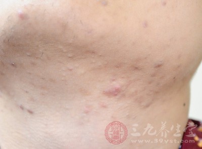脖子上长了很多痘痘什么原因,脖子上长痘痘什么原因及解决办法