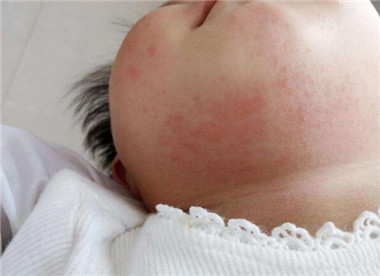 湿疹5个护理方法大家一起看一看,三个月大宝宝湿疹严重怎么护理