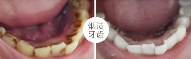 黄牙口臭的克星,牙黄口臭用什么牙膏有效果一点