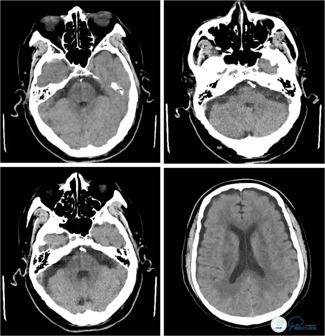 椎动脉狭窄介入手术病例汇报,基底动脉狭窄70%的介入治疗
