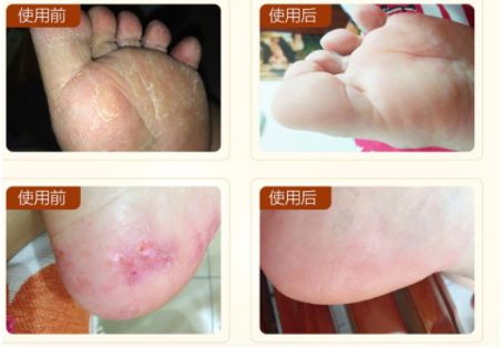 治疗脚气烂脚丫的小妙招,如何治疗脚臭脚气脚后跟开裂