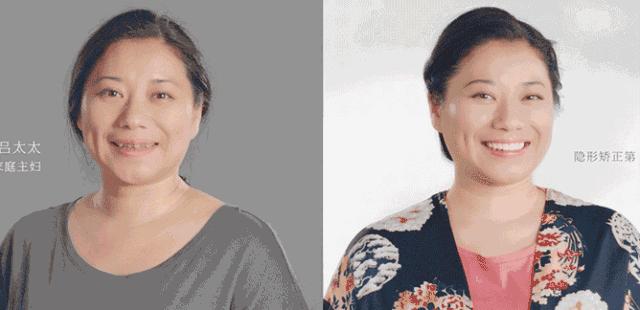 矫正牙齿不给报销吗,牙齿矫正为什么不能纳入医保