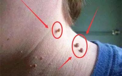 身上的瘊分公母吗,身上长瘊子为什么还分公母