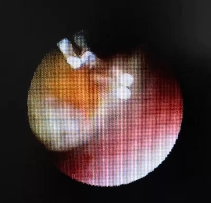 震惊！河北一岁女童鼻腔里竟取出一只蜗牛！