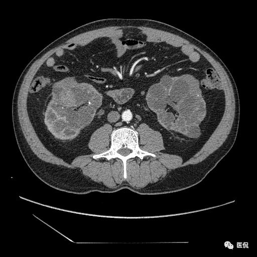 肾功能不全双肾回声稍增强怎么办,肾ct检查双肾萎缩