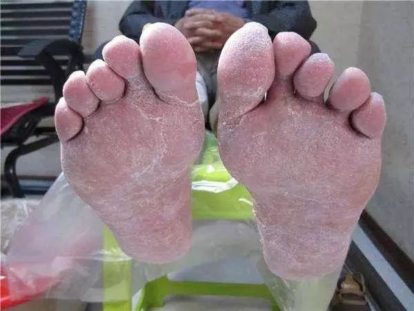 皮肤湿疹万能膏,泰国顽固性皮肤病排毒止痒膏