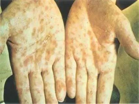 26岁男子感染梅毒,29岁男子查出梅毒