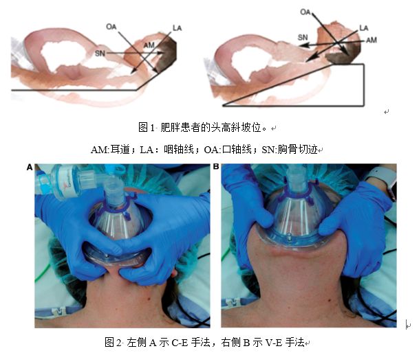 肥胖患者麻醉管理专家共识（2017）